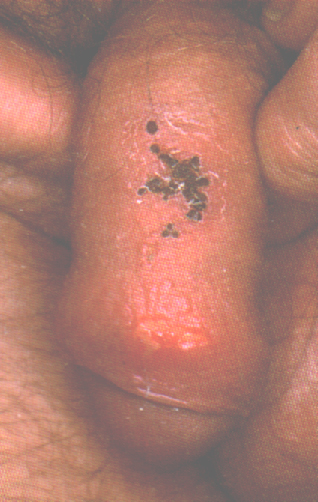 herpes genital